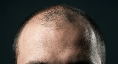 Détail macro d'une ligne de cheveux sur fond sombre montrant les premiers signes de calvitie.