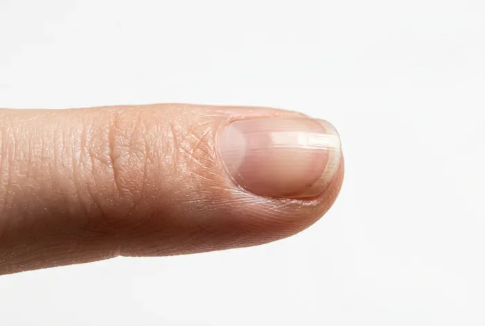 Comment soigner un ongle arraché avec faux ongle Miniature ongle endommagé pour article santé